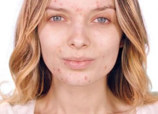 Zo kom jij van je acne af! acne