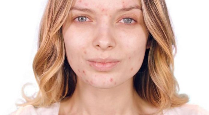 Zo kom jij van je acne af! acne